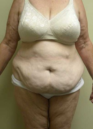Tummy tuck (Abdominoplasty) Case 4172 Before Photo Tummy tuck (Abdominoplasty)