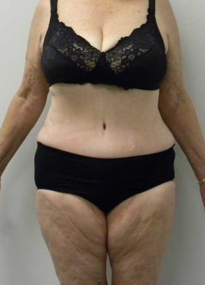 Tummy tuck (Abdominoplasty) Case 4172 After Photo Tummy tuck (Abdominoplasty)