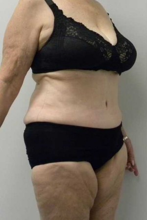 Tummy tuck (Abdominoplasty) Case 4172 After Photo Tummy tuck (Abdominoplasty)