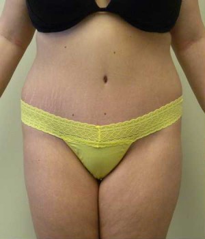 Tummy tuck (Abdominoplasty)