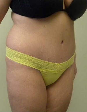 Tummy tuck (Abdominoplasty)