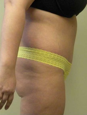 Tummy tuck (Abdominoplasty)