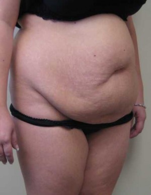 Tummy tuck (Abdominoplasty)