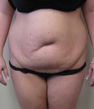 Tummy tuck (Abdominoplasty)