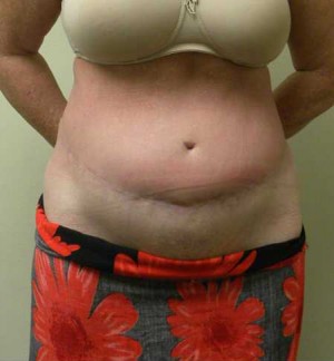 Tummy tuck (Abdominoplasty)