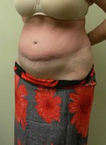 Tummy tuck (Abdominoplasty)