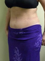 Tummy tuck (Abdominoplasty)