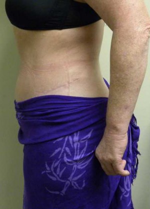 Tummy tuck (Abdominoplasty) Case 4186 After Photo Tummy tuck (Abdominoplasty)