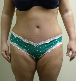 Tummy tuck (Abdominoplasty)