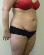 Tummy tuck (Abdominoplasty)