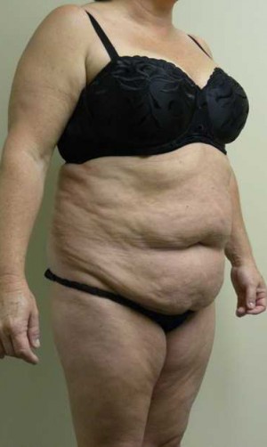 Tummy tuck (Abdominoplasty)