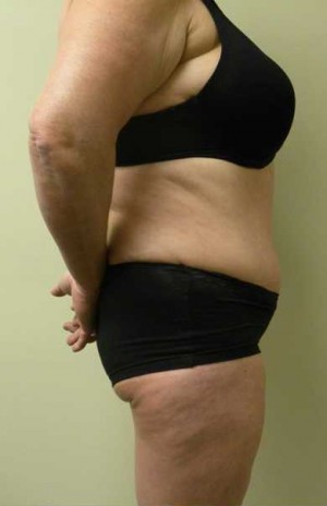 Tummy tuck (Abdominoplasty)