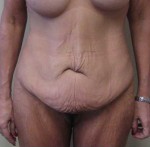 Tummy tuck (Abdominoplasty)