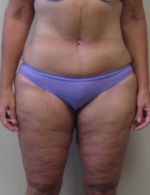 Tummy tuck (Abdominoplasty)