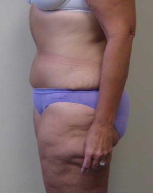 Tummy tuck (Abdominoplasty) Case 4214 After Photo Tummy tuck (Abdominoplasty)