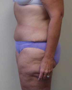 Tummy tuck (Abdominoplasty)