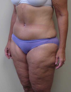 Tummy tuck (Abdominoplasty)