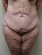 Tummy tuck (Abdominoplasty)