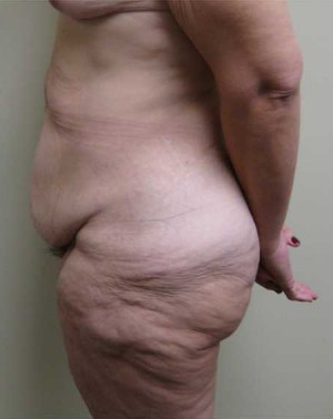 Tummy tuck (Abdominoplasty) Case 4214 Before Photo Tummy tuck (Abdominoplasty)