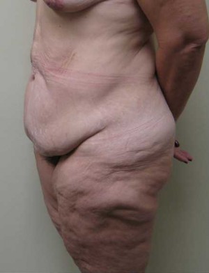 Tummy tuck (Abdominoplasty) Case 4214 Before Photo Tummy tuck (Abdominoplasty)