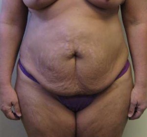 Tummy tuck (Abdominoplasty) Case 4221 Before Photo Tummy tuck (Abdominoplasty)