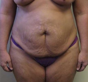 Tummy tuck (Abdominoplasty)