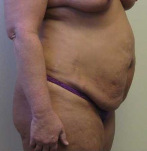 Tummy tuck (Abdominoplasty) Case 4221 Before Photo Tummy tuck (Abdominoplasty)