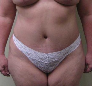 Tummy tuck (Abdominoplasty)