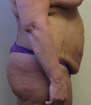 Tummy tuck (Abdominoplasty) Case 4221 Before Photo Tummy tuck (Abdominoplasty)