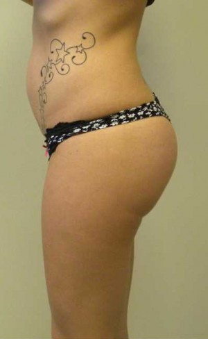 Buttock Augmentation