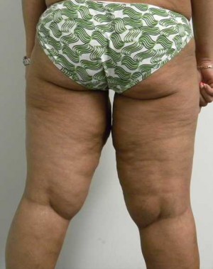 Thigh Lift Case 4235 Before Photo Thigh Lift