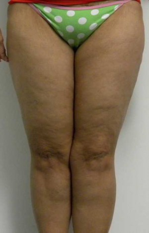 Thigh Lift Case 4235 After Photo Thigh Lift