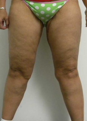 Thigh Lift Case 4235 After Photo Thigh Lift