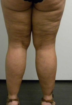 Liposuction Case 4254 Before Photo Liposuction