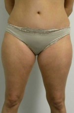 Liposuction