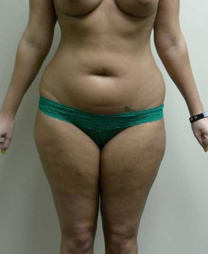 Liposuction Case 4266 Before Photo Liposuction