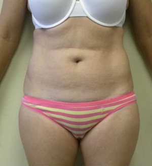 Liposuction Case 4271 After Photo Liposuction