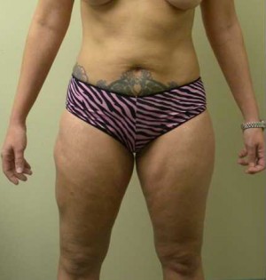 Liposuction Case 4274 Before Photo Liposuction