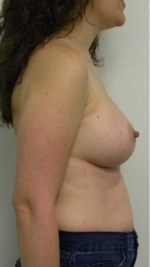Breast Augmentation Case 5026 After Photo Breast Augmentation