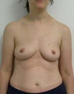 Breast Augmentation