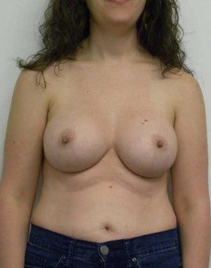 Breast Augmentation Case 5026 After Photo Breast Augmentation