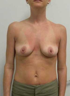 Breast Augmentation Case 5040 Before Photo Breast Augmentation