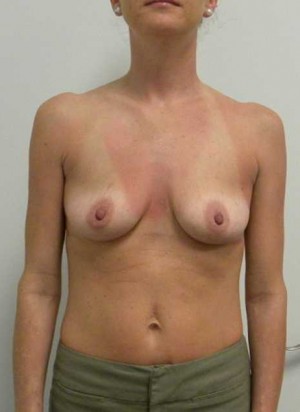 Breast Augmentation