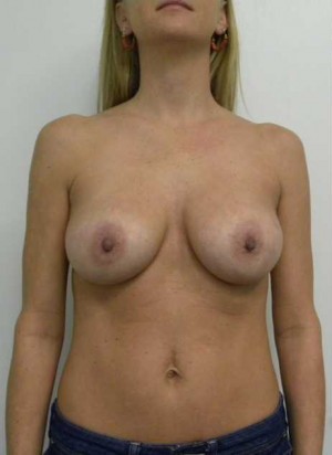 Breast Augmentation Case 5040 After Photo Breast Augmentation