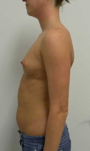 Breast Augmentation Case 5045 Before Photo Breast Augmentation