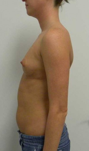 Breast Augmentation