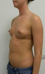 Breast Augmentation