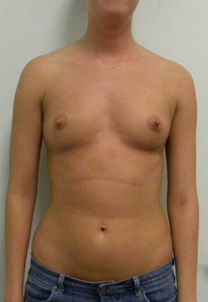 Breast Augmentation Case 5045 Before Photo Breast Augmentation