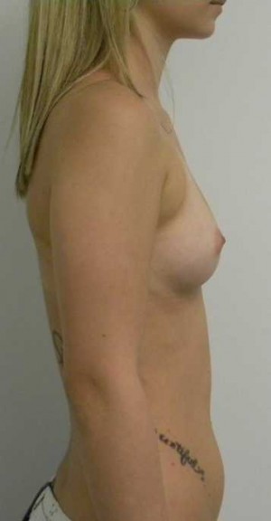 Breast Augmentation Case 5059 Before Photo Breast Augmentation