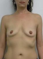 Breast Augmentation